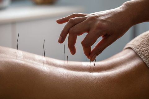 A Complete Guide to Acupuncture for Chronic Pain Relief: How It Helps Arthritis, Migraines, and Back Pain